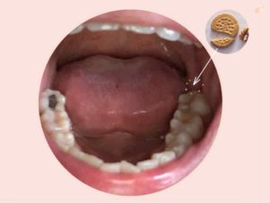 Acute gingival swelling 急性牙齦腫脹 mouth